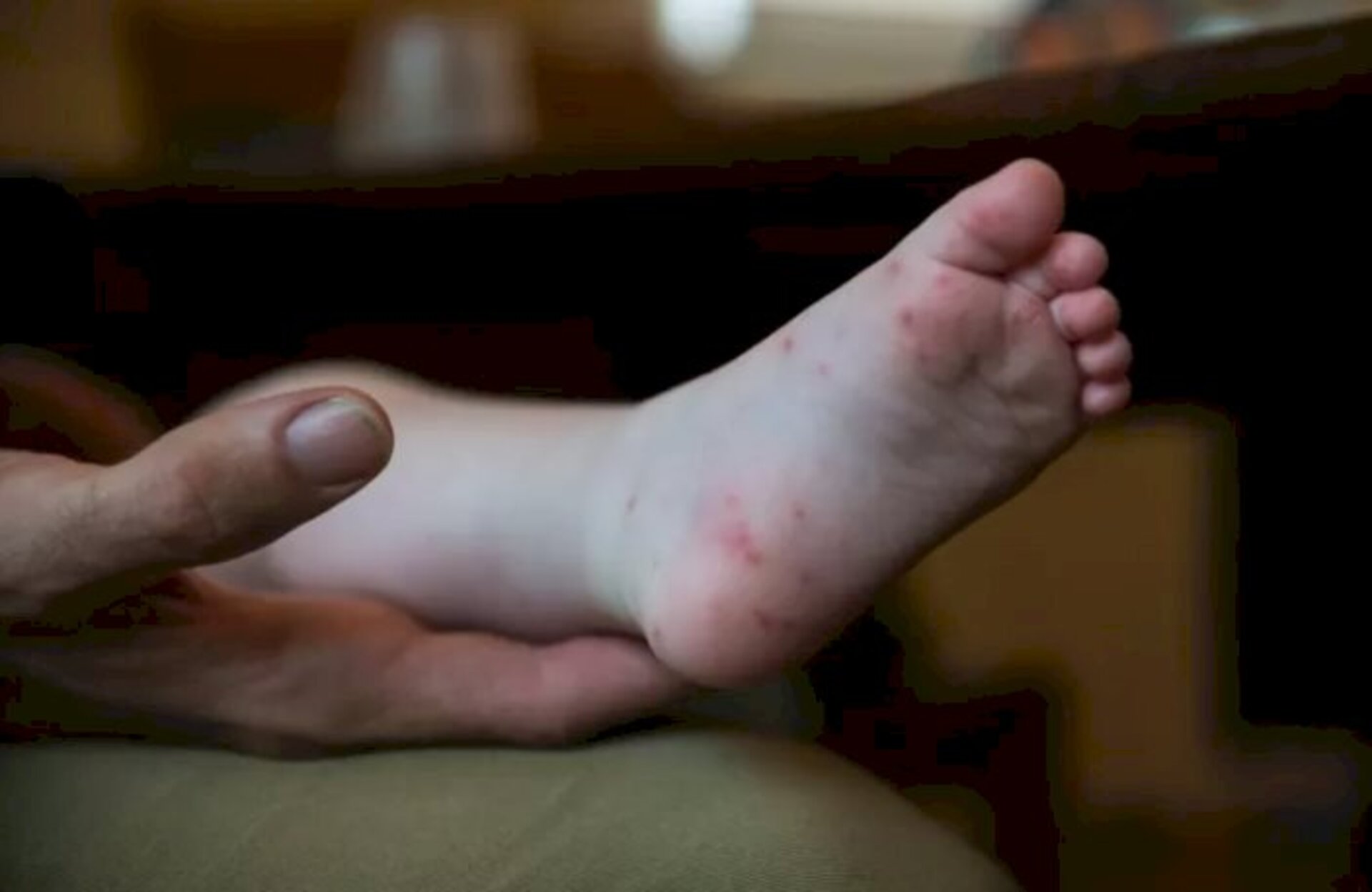 Crianças são mais acometidas pelo vírus